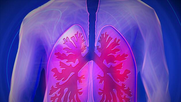 Lungenfibrose: So entsteht die Narbenlunge