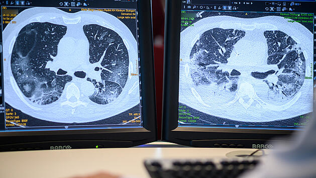 Auf zwei Monitoren sind am Klinikum Stuttgart Computertomographieaufnahmen der Lunge eines Covid19-Patienten zu sehen.