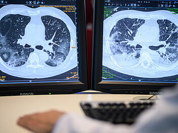 Auf zwei Monitoren sind am Klinikum Stuttgart Computertomographieaufnahmen der Lunge eines Covid19-Patienten zu sehen.