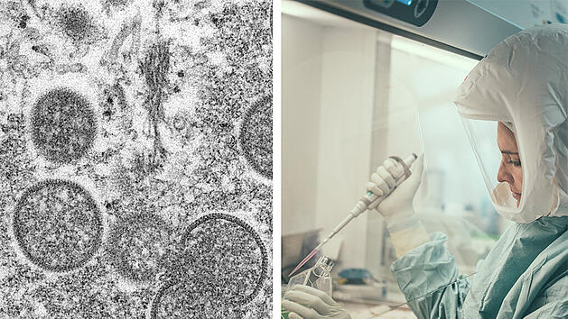 Affenpocken mutieren zehnmal schneller als zuvor: M&ouml;gliche Gefahr? Das steckt dahinter