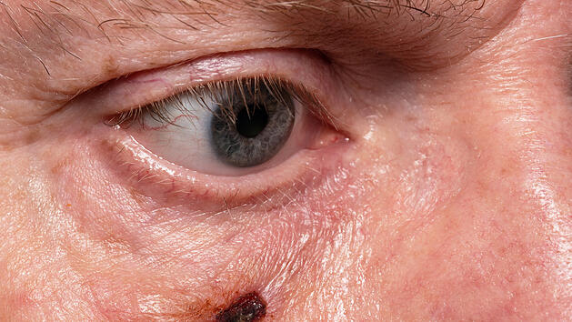 Weißer Hautkrebs am Auge - so erkennst du Basaliome