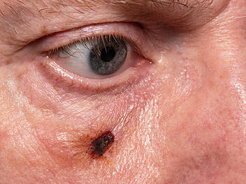 Weißer Hautkrebs am Auge - so erkennst du Basaliome