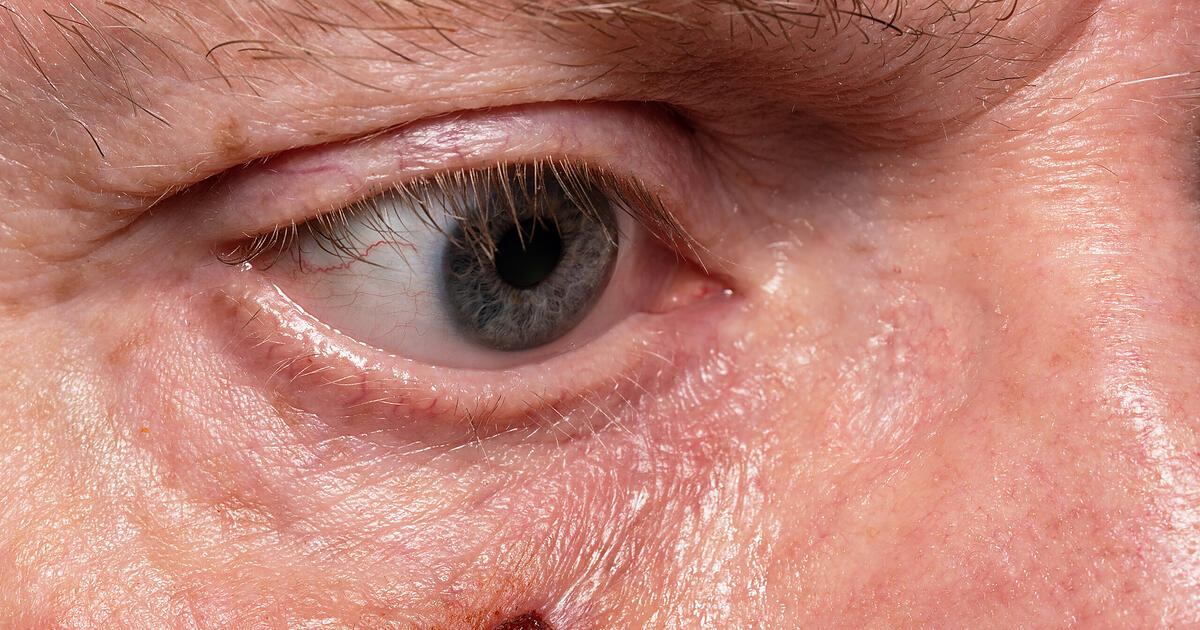 Basaliome am Auge So erkennst du weißen Hautkrebs