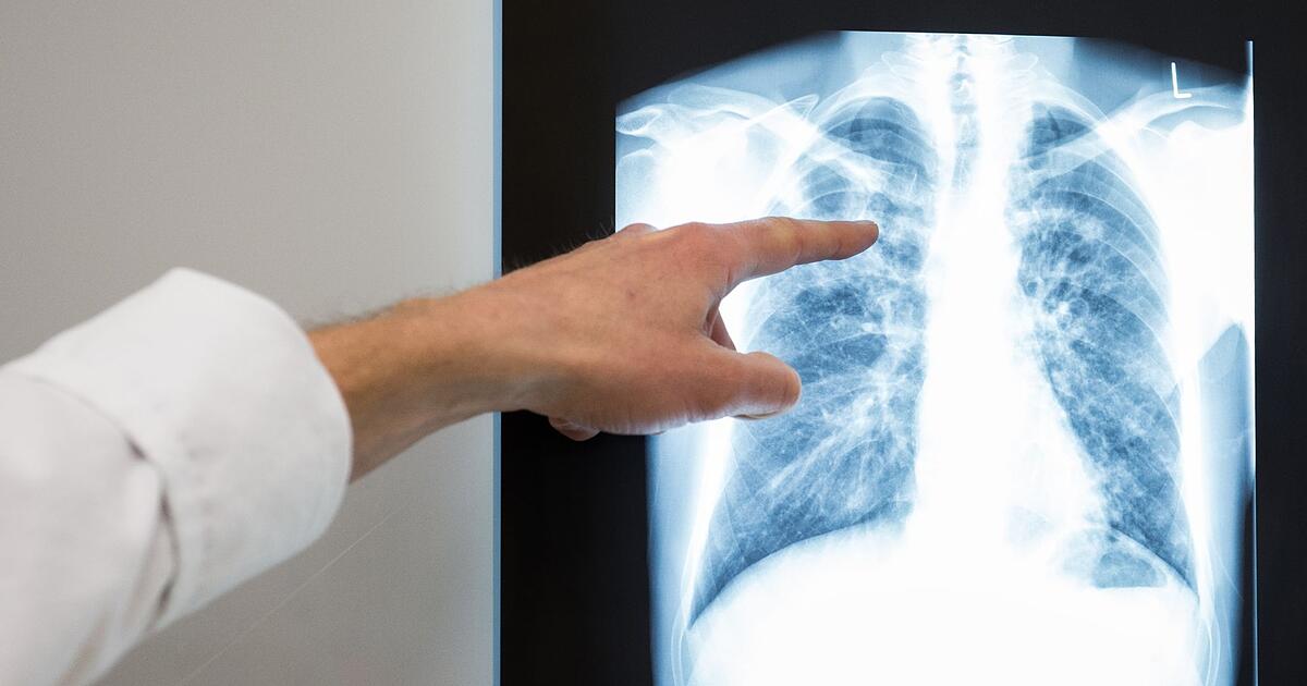 Wendelstein: Health department reports tuberculosis case at school