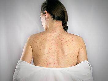 Syphilis, Behandlung Windpocken Virusinfektion, Hautausschläge