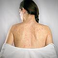 Syphilis, Behandlung Windpocken Virusinfektion, Hautausschläge