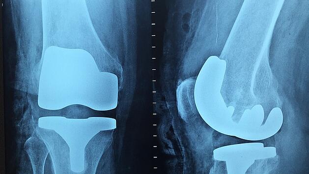Ein k&uuml;nstliches Kniegelenk im R&ouml;ntgenbild.