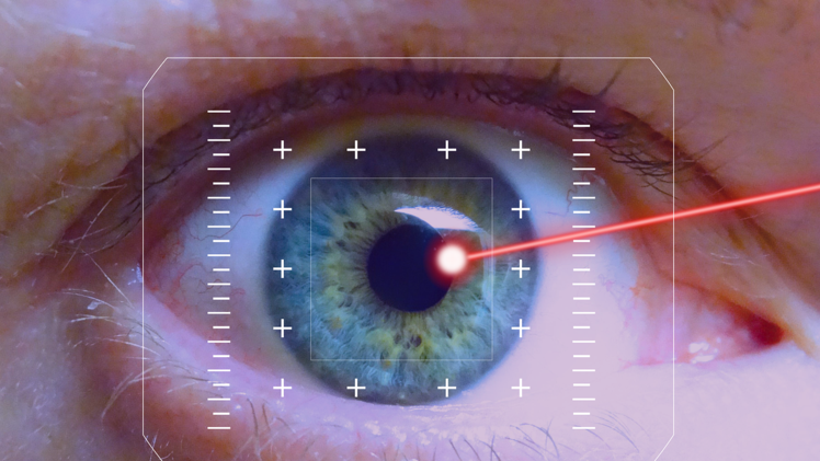 Laseroperationen am Auge gelten als zunehmend risikoarm und dauern heutzutage nur noch eine halbe Stunde.