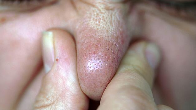 Einem Spieler der Essener SG wurde im Spiel gegen Preussen Eiberg ein St&uuml;ck seiner Nase abgebissen. Der T&auml;ter sah f&uuml;r die Attacke die Rote Karte und bekommt demn&auml;chst wohl Post von der Polizei. Symbolfoto: Oliver Berg/dpa