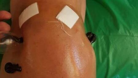 Zwei saugen schon, der dritte sitzt noch im Glas (links). Sie sollen Blut aus einem Knie saugen.  Susanne Will