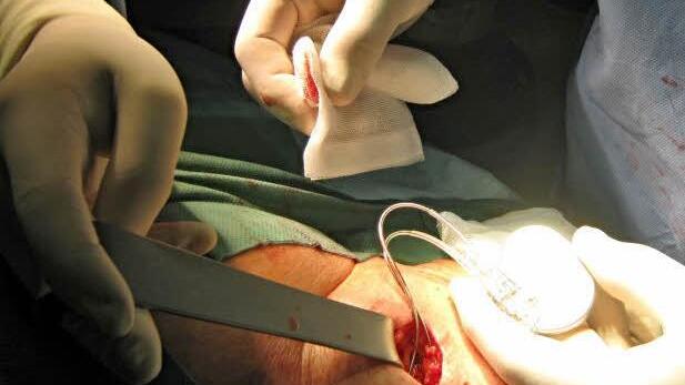 Das Foto zeigt, wie bei Helmut Schramm der Herzschrittmacher gelegt wird.  Foto: Krankenhaus Ebern
