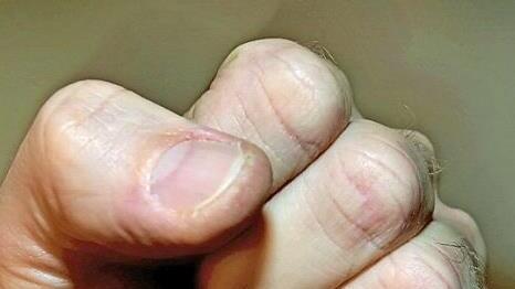 Im Rausch lie&szlig; ein 21-J&auml;hriger die F&auml;uste sprechen. Symbolfoto: dpa/Archiv