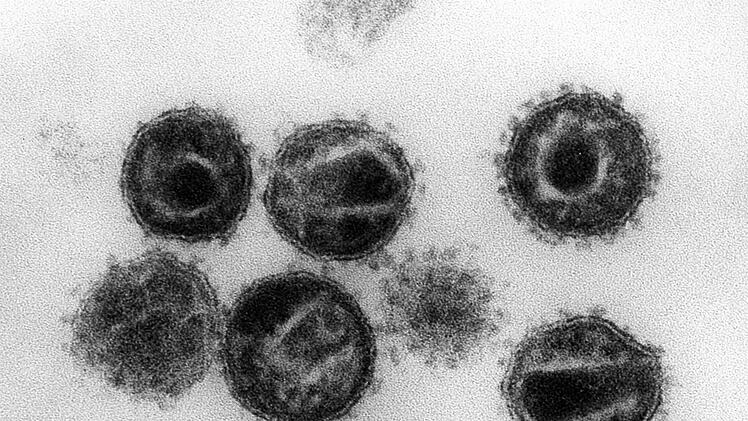 Eine undatierte elektronenmikroskopische Aufnahme zeigt mehrere Humane Immunschwäche-Viren (HIV). Foto: Hans Gelderblom/Robert Koch Institut/dpa