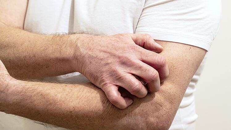 Kontaktallergien führen zu unangenehmen Hautreaktionen, sind aber mit der richtigen Behandlungsmethode heilbar.