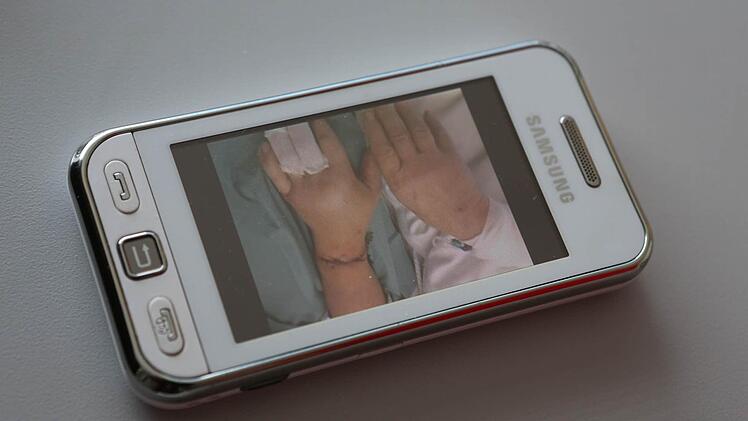 Eine Aufnahme auf Müllichs Handy zeigt die angenähte Hand.  Foto: Barbara Herbst