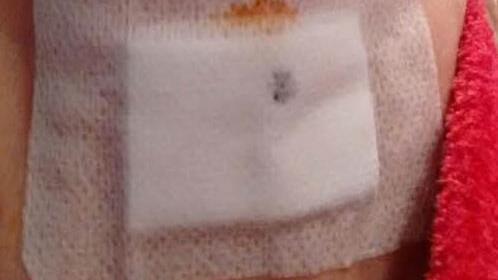 Auch eine FT-Mitarbeiterin wurde in diesem Jahr schon von einer Zecke gebissen  Foto: privat