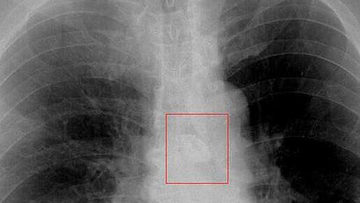 Ärzte entfernen verschluckte und vergessene Münze aus Lunge