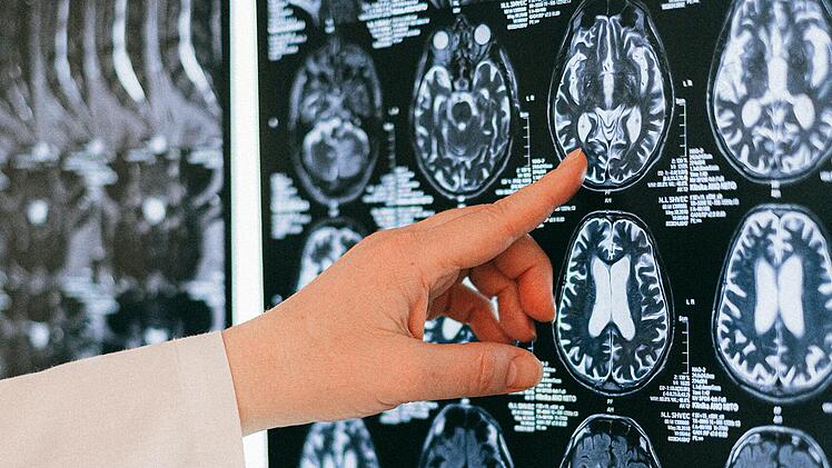Epilepsie ist eine Fehlfunktion des Gehirns.