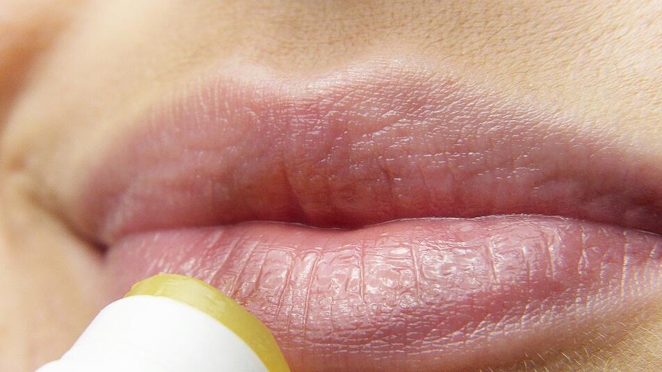 Lippenherpes: Das hilft gegen die schmerzhaften Bläschen an den Lippen