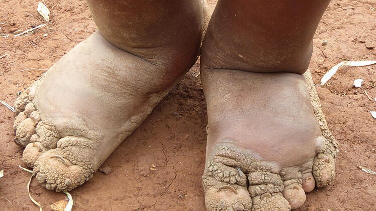 Eine Kind leidet an Elephatiasis.