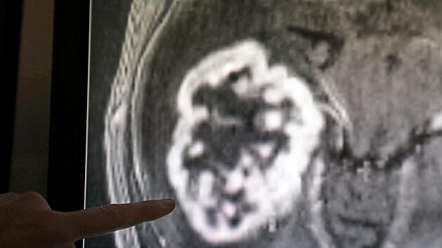 B&uuml;rgervorlesung am Uniklinikum Erlangen &uuml;ber die Behandlung seltener Tumore