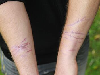 Die Narben werden dem jungen Sportler erhalten bleiben.