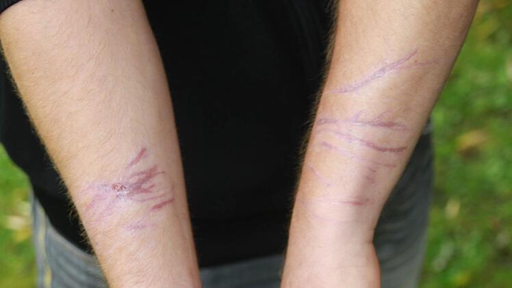 Die Narben werden dem jungen Sportler erhalten bleiben.