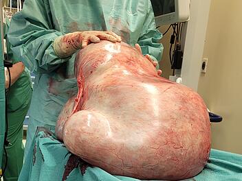 Magdeburg: Angst vor Operation l&auml;sst Tumor bis 32 Kilogramm wachsen - &Auml;rzte entfernen ihn erfolgreich