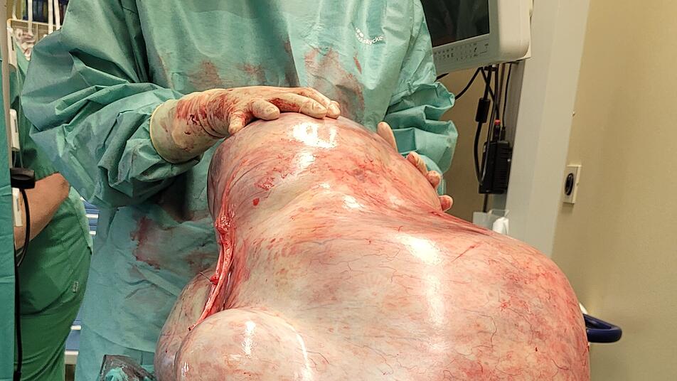 Weil sie Angst vor einer Operation hatte Frau aus Magdeburg wird 32 Kilogramm schwerer Tumor