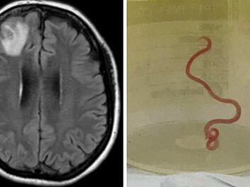 Wurm im Gehirn: Sensationeller Fund bei Frau in Australien