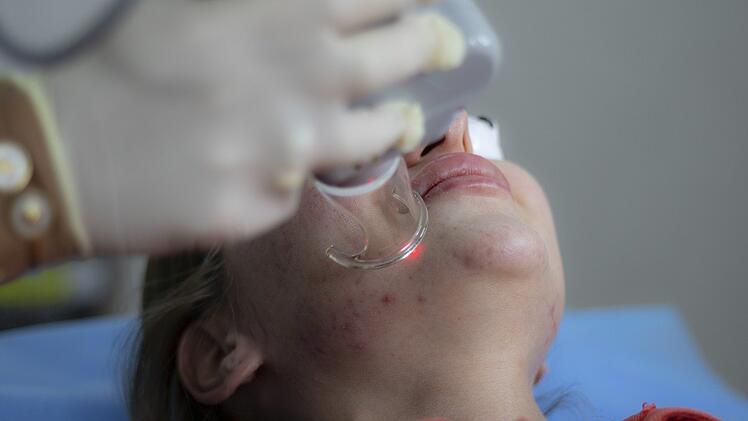 Viele Frauen lassen sich auch im Gesicht lasern, um kleinste Haare zu entfernen.