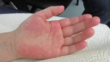 Hautausschläge sind ein häufiges Symptom bei PIMS. Foto: Regiomed Kliniken GmbH