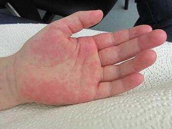 Hautausschläge sind ein häufiges Symptom bei PIMS. Foto: Regiomed Kliniken GmbH