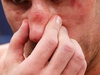 In einer Kulmbacher Kneipe hat ein 25-Jähriger einem anderen Mann in die Nase gebissen. Dafür musste er sich jetzt vor Gericht verantworten. Symbolfoto: Rolf Vennenbernd, dpa