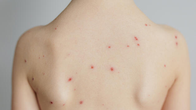 Windpocken, Kinderkrankheit, Haut, Krankheit, Erkrankung, Virus