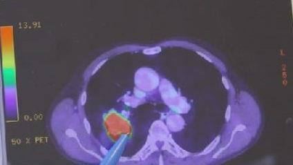 Lungentumor-Ausschnitt. Foto:  Simon Dellert