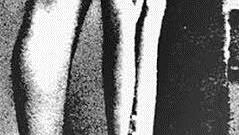 Ein überlebendes Opfer von Karl Gebhardts Gasbrandversuchen. Die lebenslang schwer geschädigte Frau wurde beim Nürnberger Ärzteprozess gehört. Foto: Dubistanders