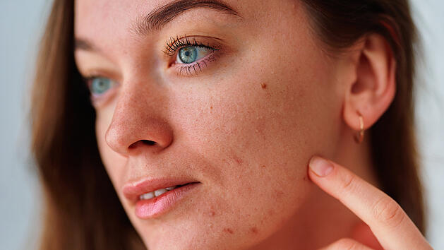 Hautprobleme Unreinheiten Akne zu hohes Cholesterien