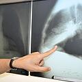 In einem Krankenhaus im französischen Montpellier ist eine Patientin an Lungenkrebs gestorben. Kurz zuvor wurde ihr eine Raucherlunge transplantiert. Symbolfoto: Felix Hörhager dpa/lby