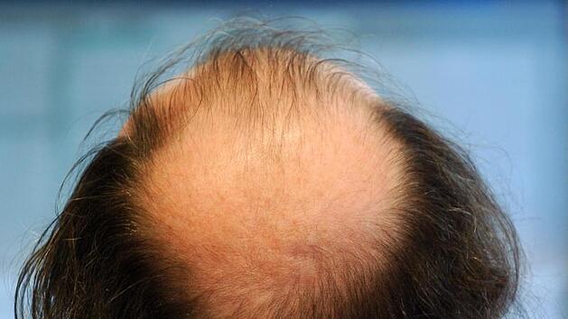 Durchbruch bei Forschung zu Haarausfall: Dieser nat&uuml;rliche Zucker k&ouml;nnte die L&ouml;sung sein
