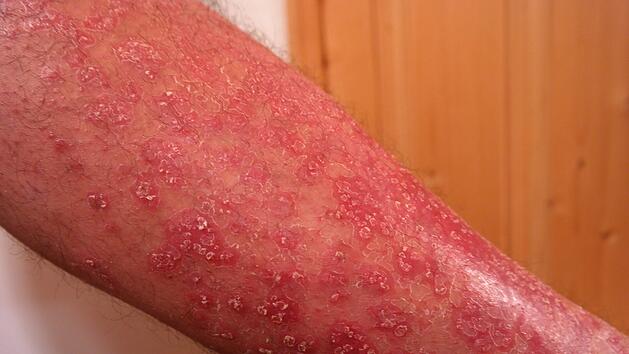Schuppenflechte, Psoriasis