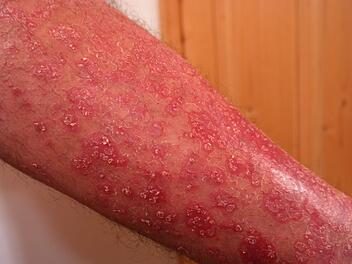 Schuppenflechte, Psoriasis