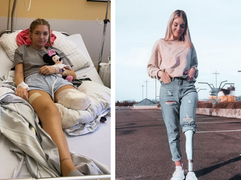 N&uuml;rnberg: Anna verliert ihr Bein durch Krankenhauskeime - nun f&auml;ngt sie mit Prothese neu an