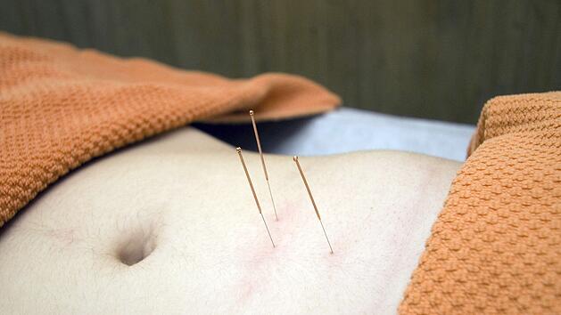 Akupunktur