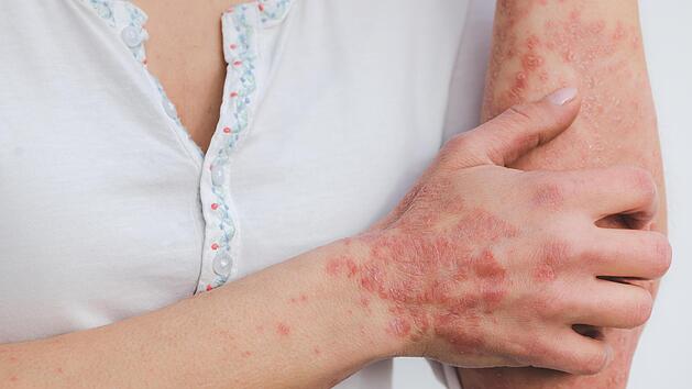 Psoriasis, Hautkrankheit, Schuppenflechte, Ausschlag