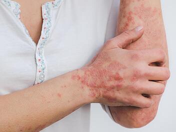 Psoriasis, Hautkrankheit, Schuppenflechte, Ausschlag