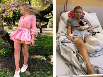 N&uuml;rnberg: Anna (19) f&auml;ngt sich Krankenhauskeime ein - und verliert ihr Bein