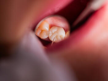 Starb M&auml;dchen (4) bei Zahnarztbesuch durch verunreinigten Narkosemittel?