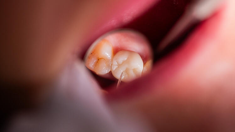 Starb M&auml;dchen (4) bei Zahnarztbesuch durch verunreinigten Narkosemittel?