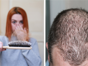 Haarausfall: Erlanger Forschern gelingt Durchbruch – Wirkstoff zeigt keine Nebenwirkungen